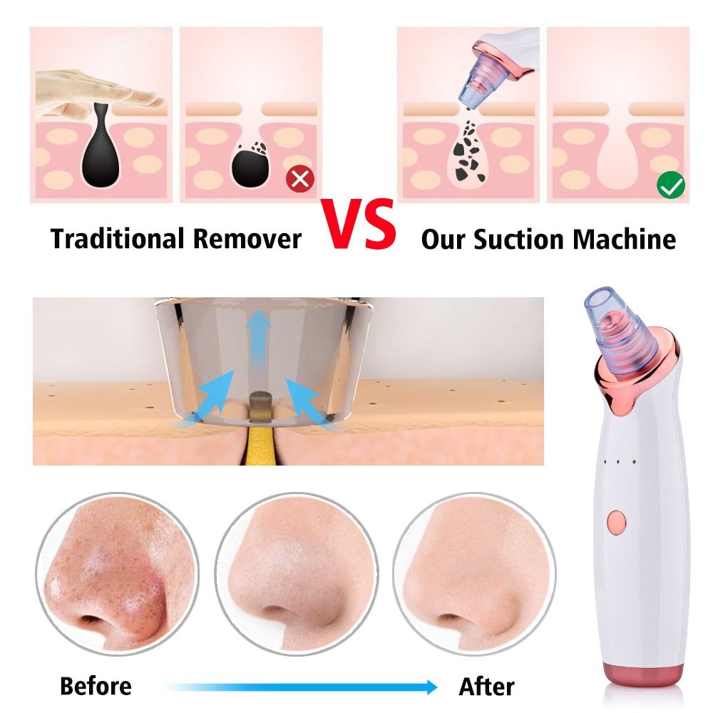 ✨ Electric Blackhead Remover – Deep Pore Cleansing Vacuum